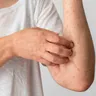 Can You Be Allergic to Marijuana?