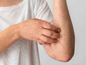 Can You Be Allergic to Marijuana?