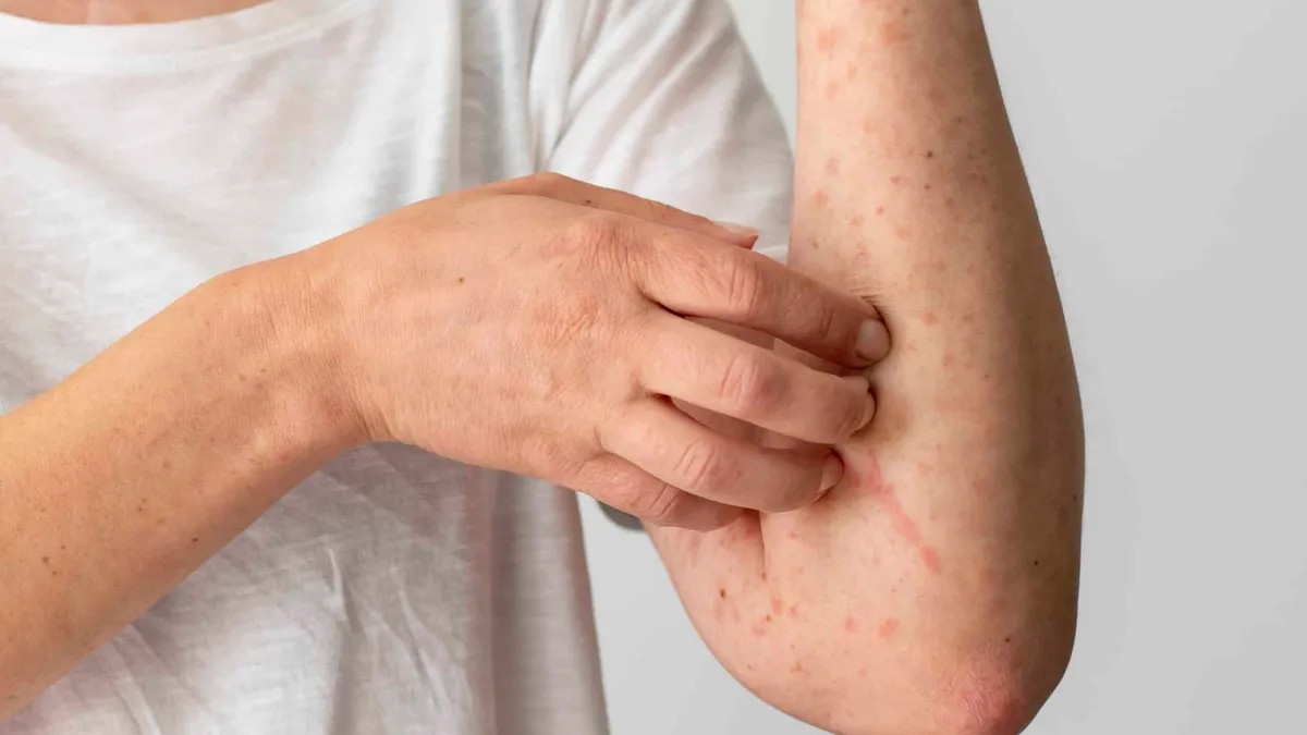 Can You Be Allergic to Marijuana?