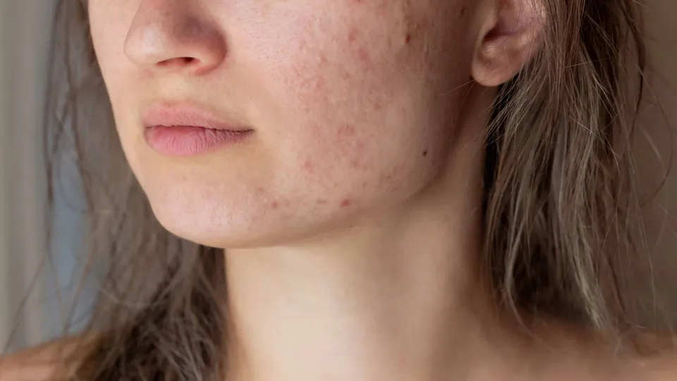 Is Medical Cannabis an Effective Acne Treatment?