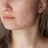 Is Medical Cannabis an Effective Acne Treatment?