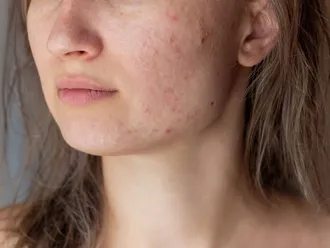 Is Medical Cannabis an Effective Acne Treatment?