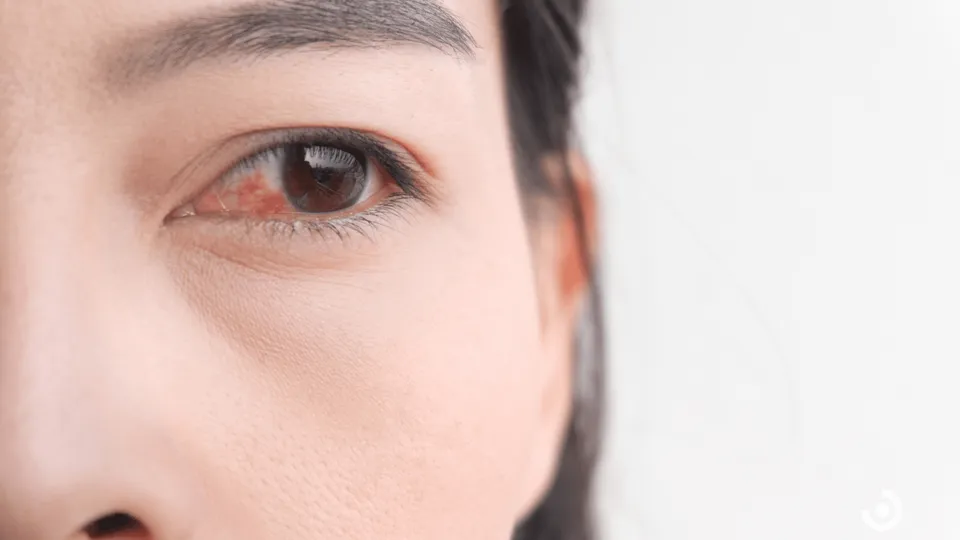 Why Does Weed Make Your Eyes Red?