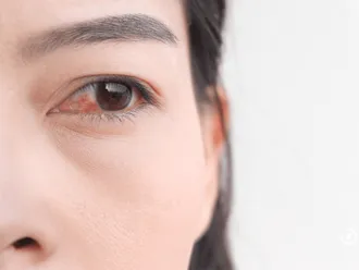 Why Does Weed Make Your Eyes Red?